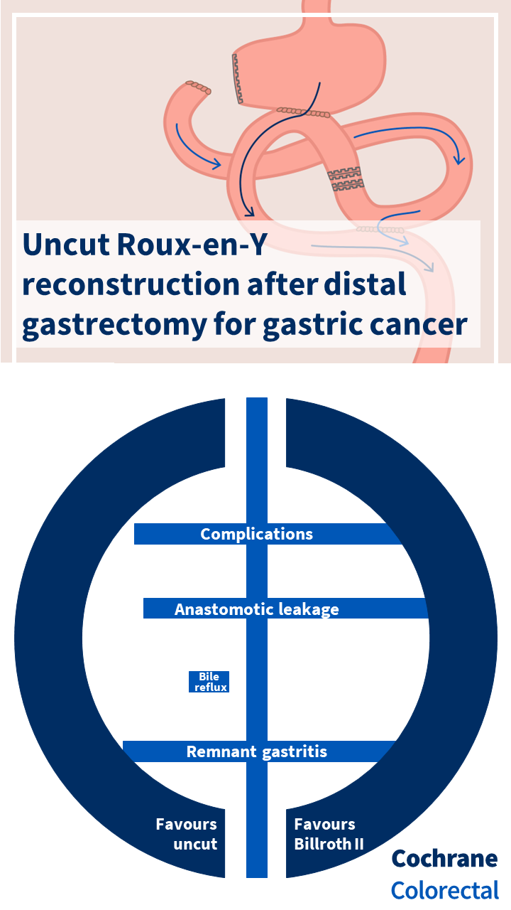 Visual abstract for Cochrane review: Uncut Roux-en-Y reconstruction after distal gastrectomy for gastric cancer