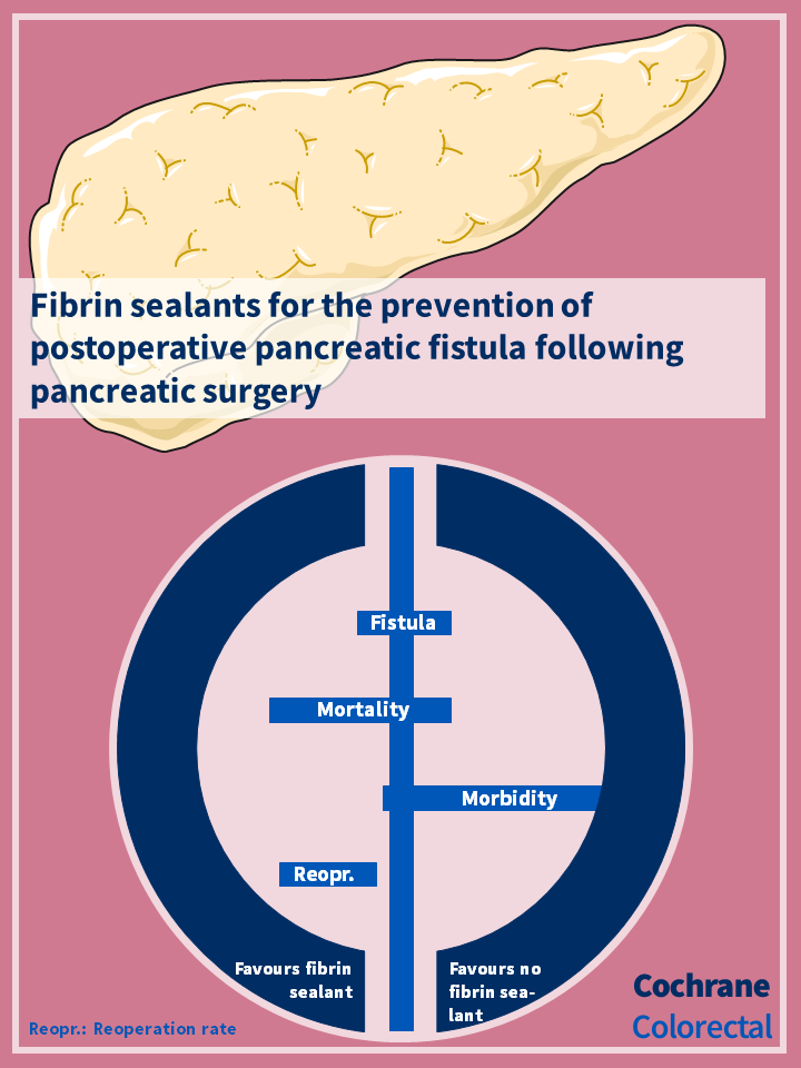 Cochrane review: Fibrin sealants for the prevention of postoperative pancreatic fistula following pancreatic surgery